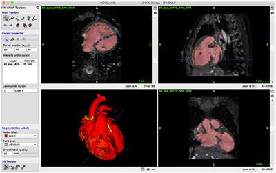 Affordable Three-Dimensional Printed Heart Models